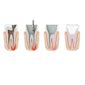 ROOT CANAL SURGERY